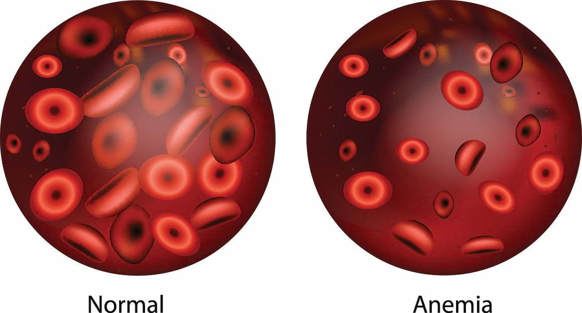 Anemia feriprivă: cauze, simptome, tratament