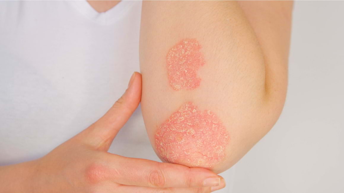Psoriazisul iti provoaca oboseala?