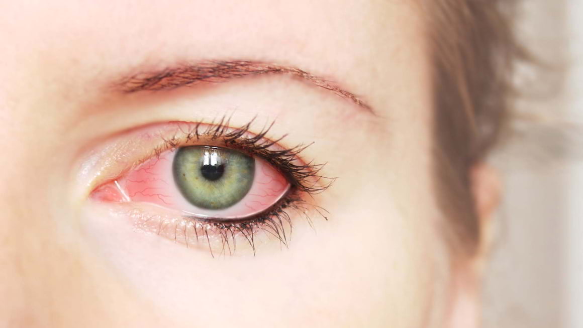Conjunctivita alergica: simptome, cauze, tratament