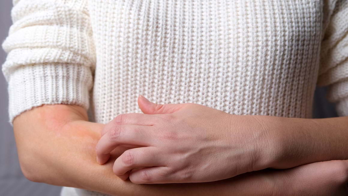 Urticaria: cauze, simptome si tratament