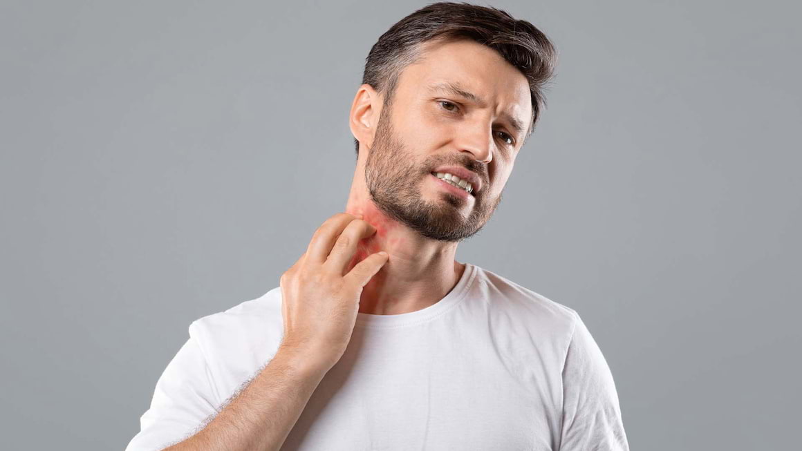 Urticaria solara: cauze, simptome si tratament