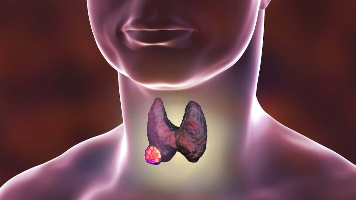 Simptome ale cancerului tiroidian pe care nu trebuie sa le ignori
