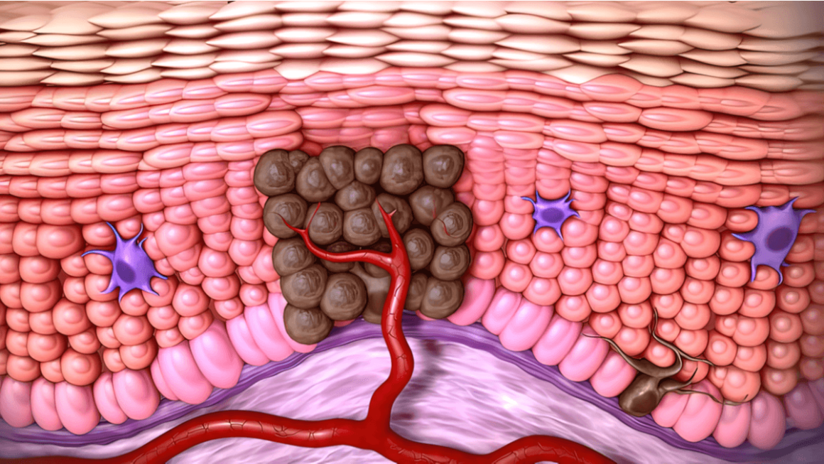 Totul despre Carcinomul Bazocelular și Carcinomul Scuamocelular