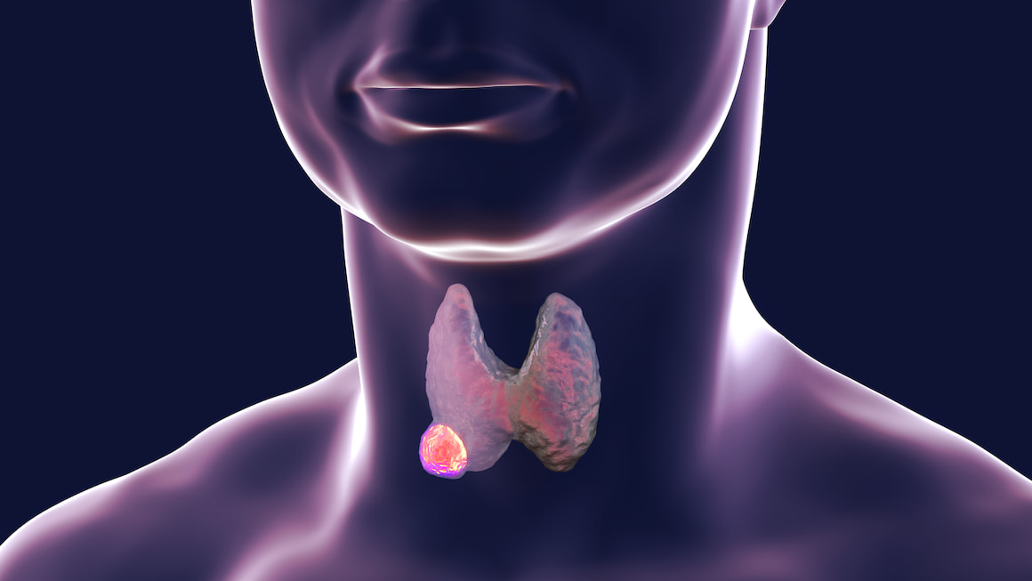 Neoplasmele tiroidiene (nodulii tiroidieni): cauze, simptome, tratament