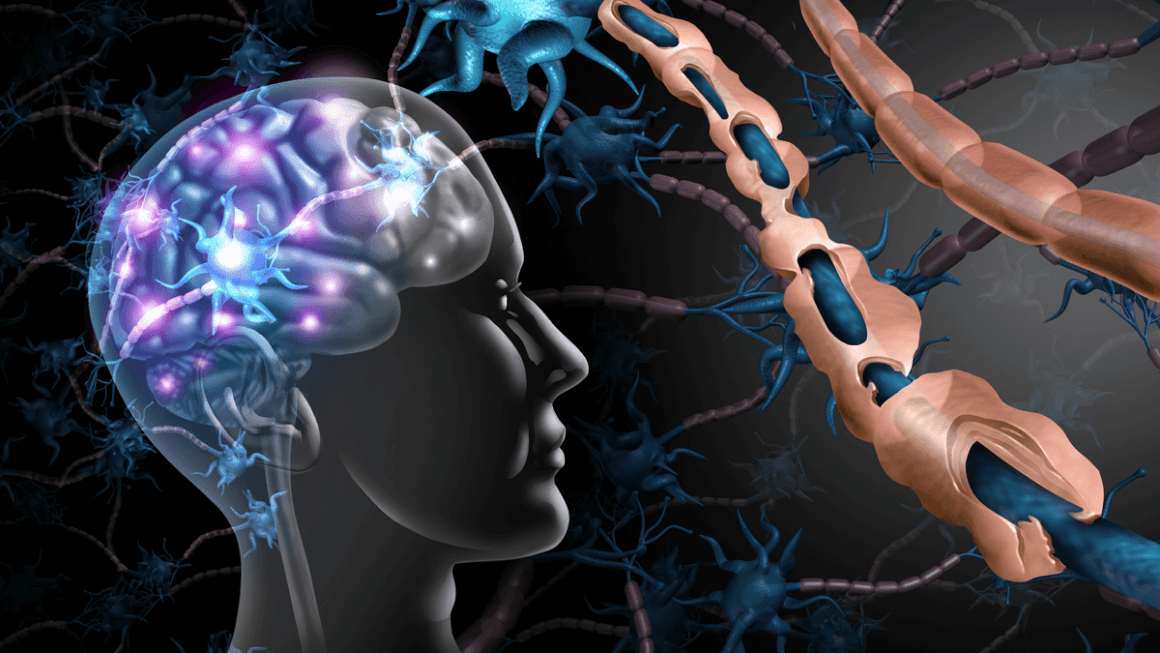 Scleroza multiplă: cauze, simptome, diagnostic și tratament