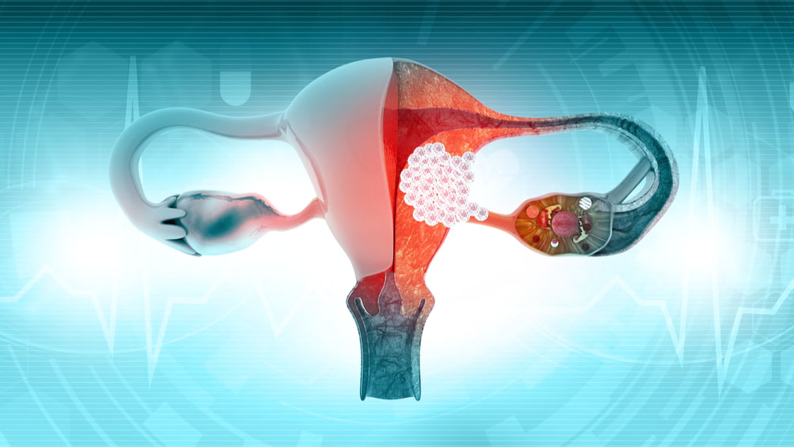 Cancerul uterin - prezent si perspective