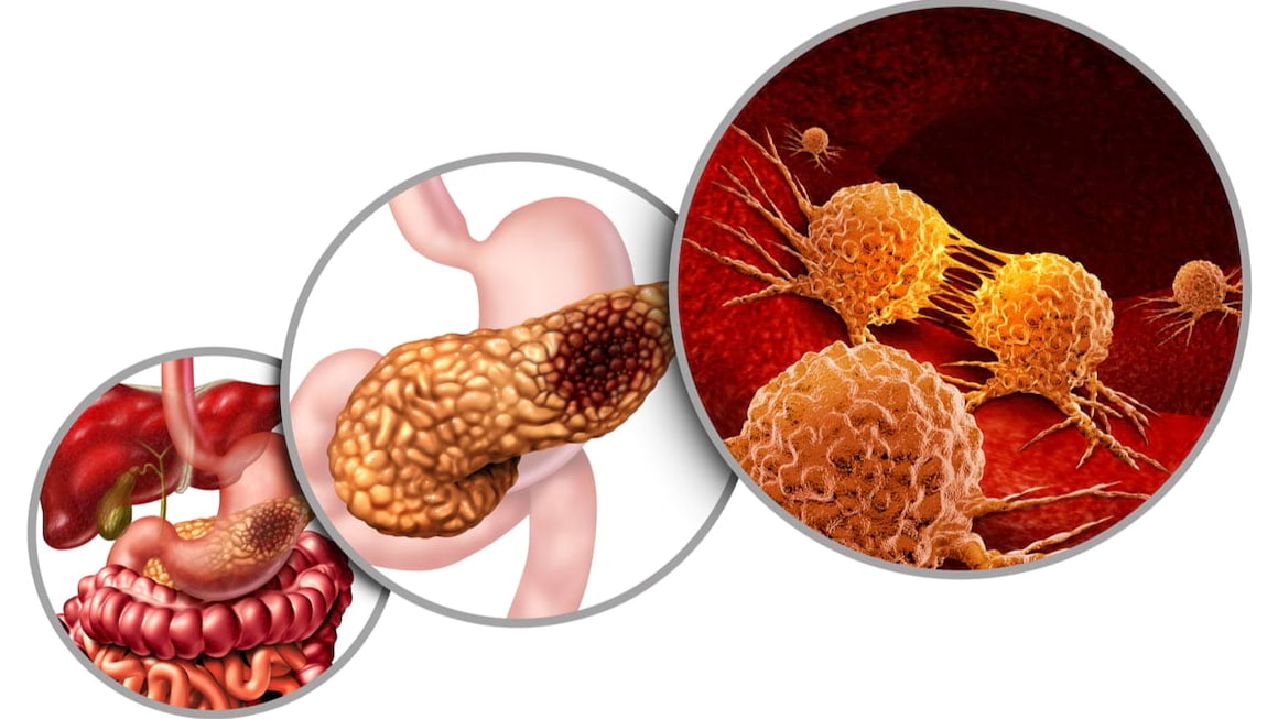 Cancerul pancreasului exocrin, sperante pentru un prognostic mai bun?