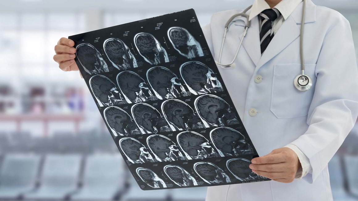 Riscul de AVC ischemic la pacientul cu dislipidemie necontrolata terapeutic