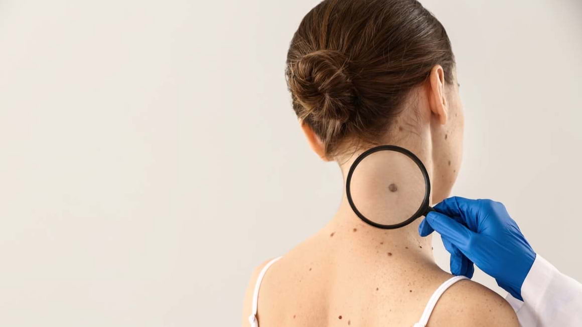 Melanomul malign familial: cauze si factori de risc
