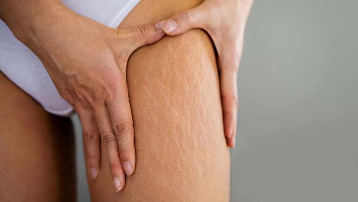 Totul despre vergeturi: Cauze ● Preventie ● Tratamente