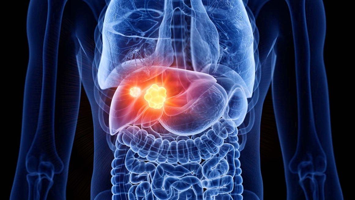 Moartea celulara fiziologica favorizeaza cancerul la ficat