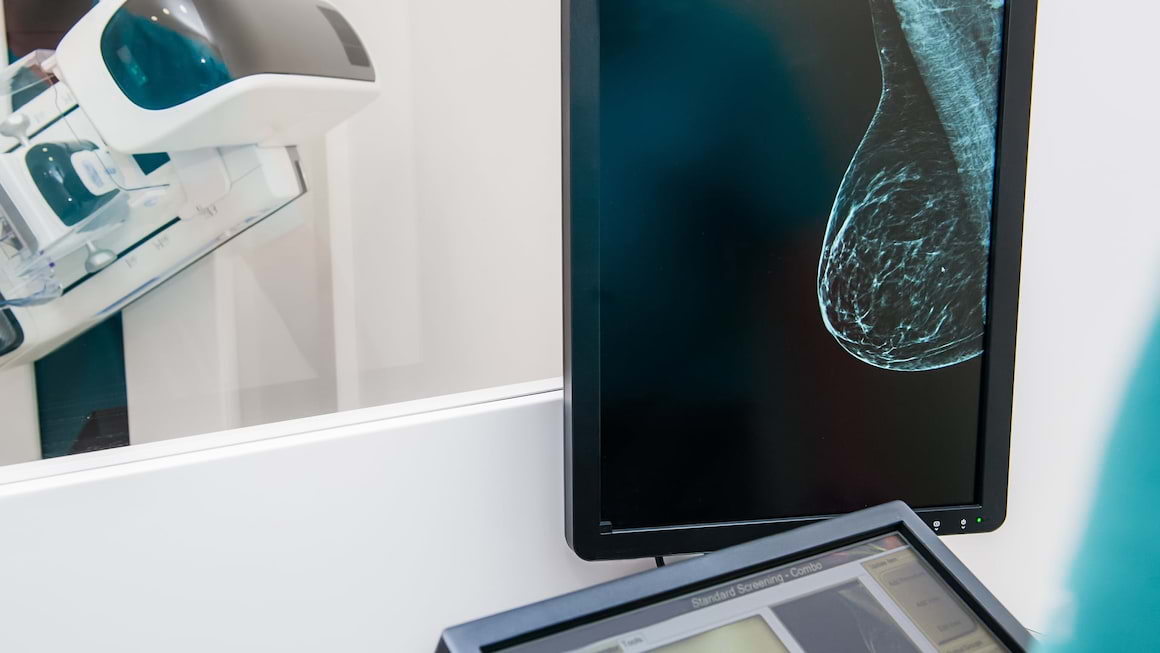 Cancerul mamar: ce reprezinta ER pozitiv sau ER negativ