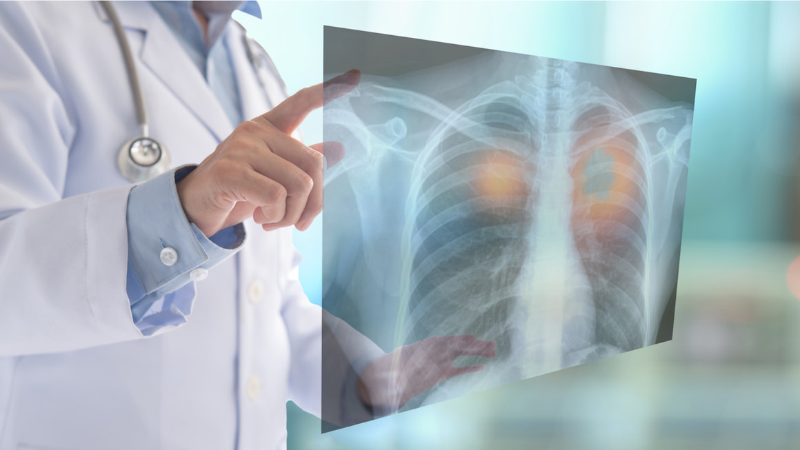 Tratamentul cancerului pulmonar