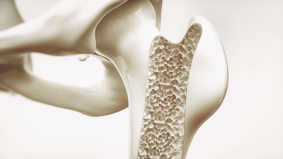 Osteoscleroza: cauze, simptome și tratament