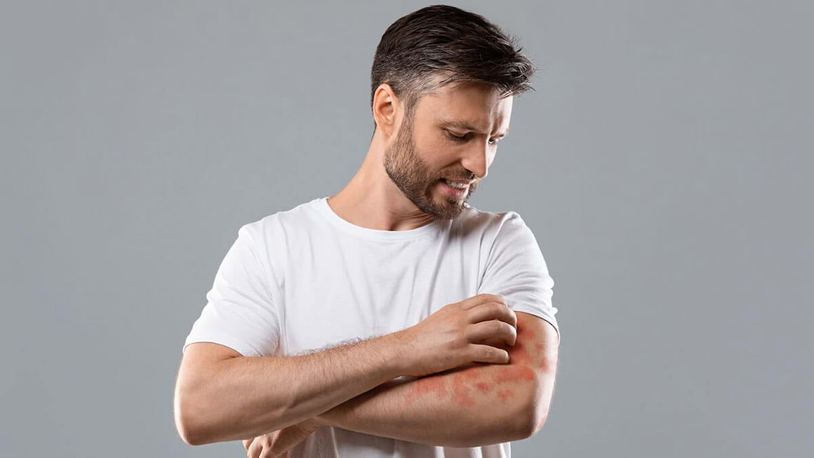Alimentația în dermatita atopică: ce este recomandat și ce nu?