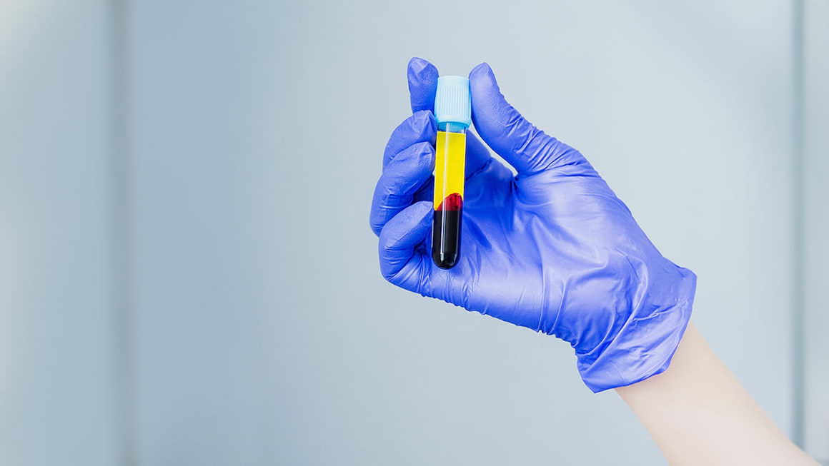 Este plasma bogată în trombocite de ajutor în artroză?