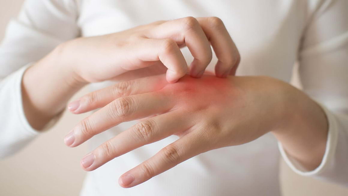 Tinea versicolor sau pitiriazis: ce este și cum se tratează corect infecția