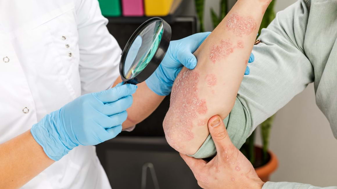 Psoriazis vs cancer de piele - cum deosebesti aceste afectiuni