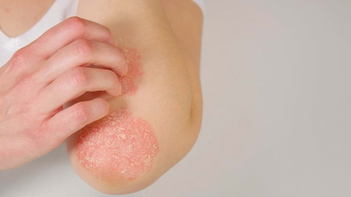 Psoriazisul in sarcina: simptome & tratament
