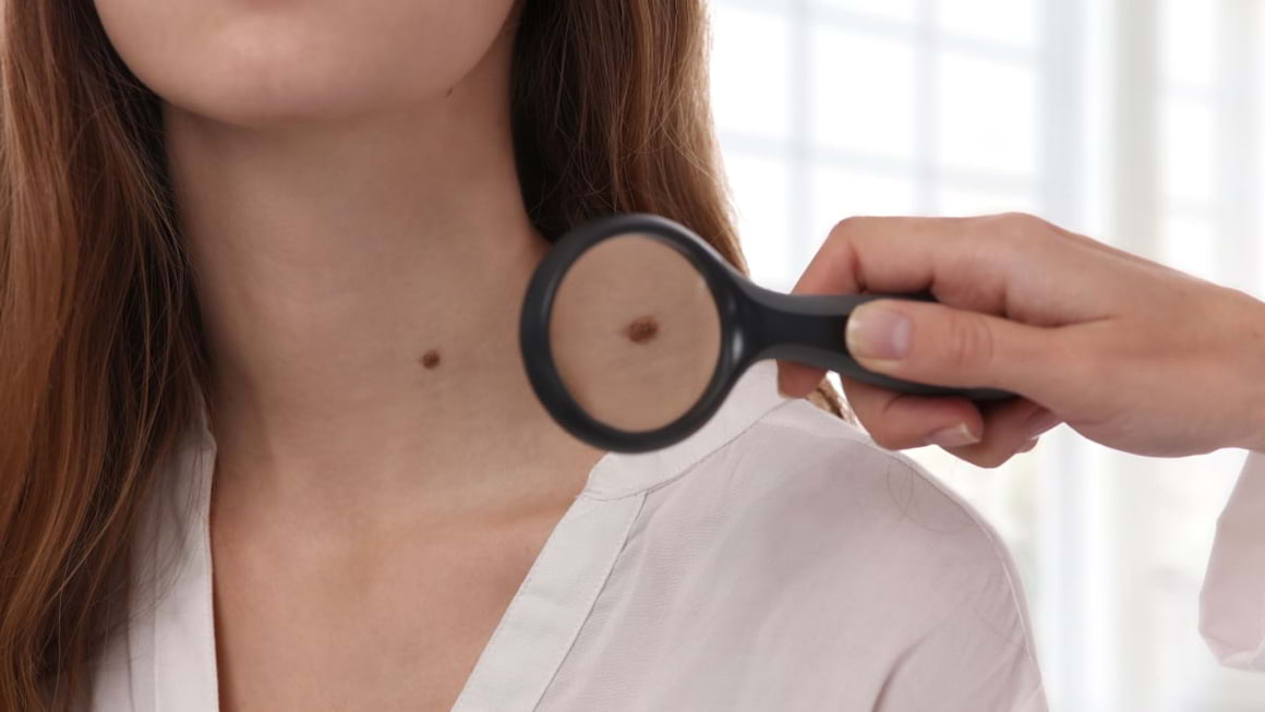 Cat de des ne autoexaminam alunitele si cat de des mergem la dermatolog?