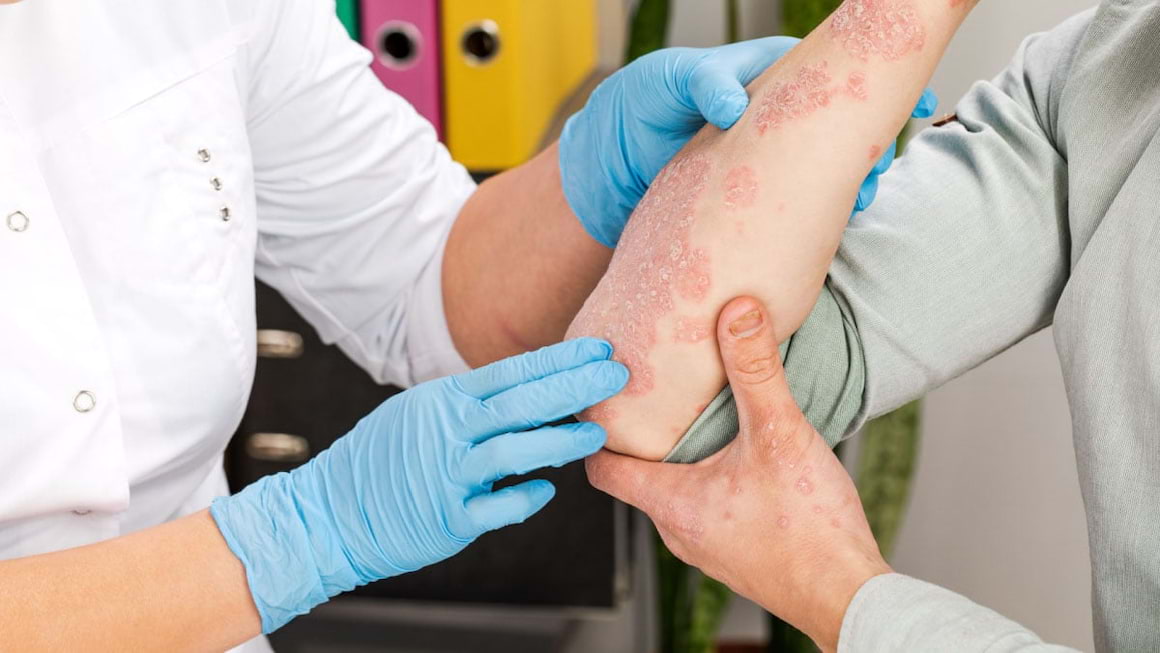 Psoriazisul: care sunt cauzele, cum se manifesta boala si cum se trateaza?
