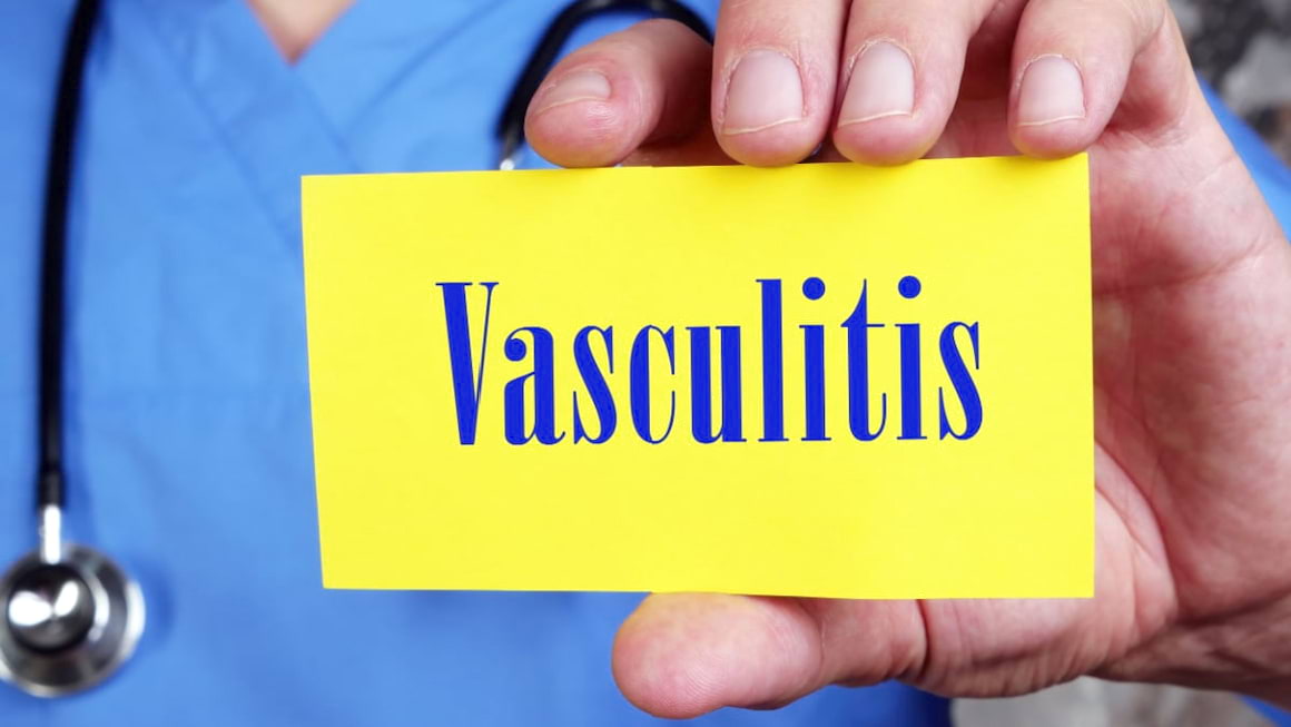 Vasculita: tipuri, simptome, tratament
