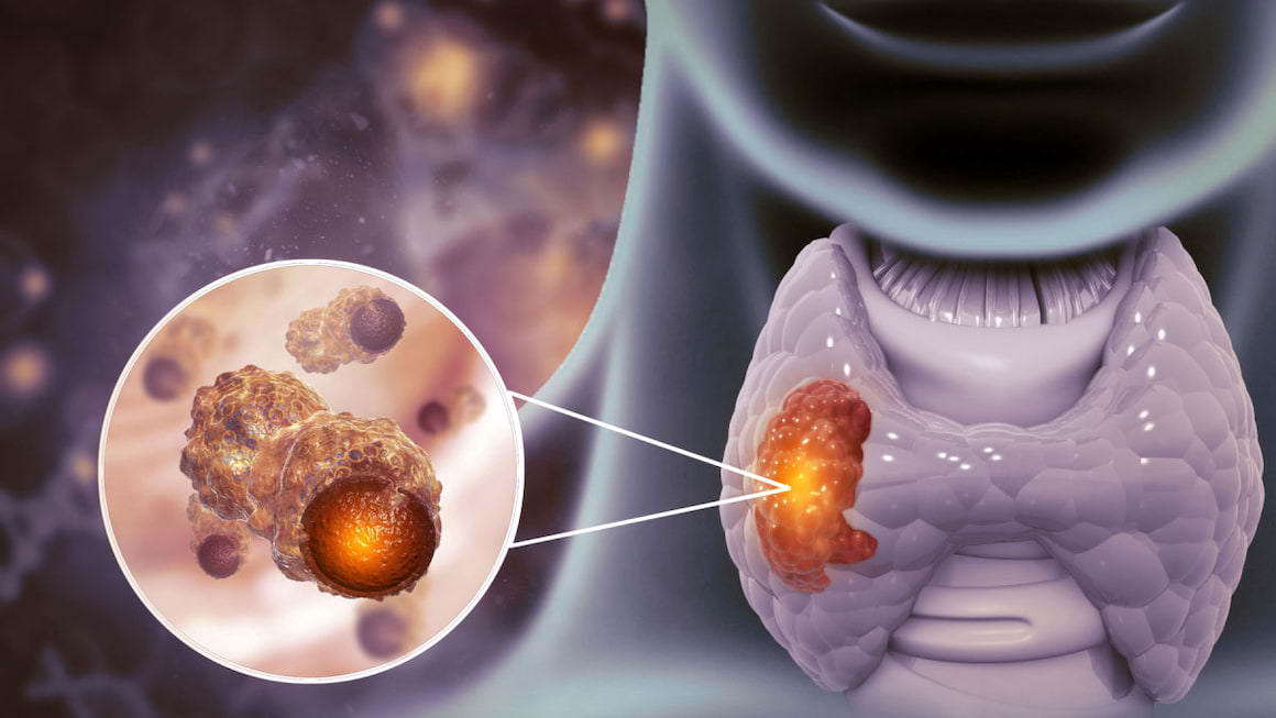 Cancerul tiroidian anaplazic: cauze, simptome & tratament