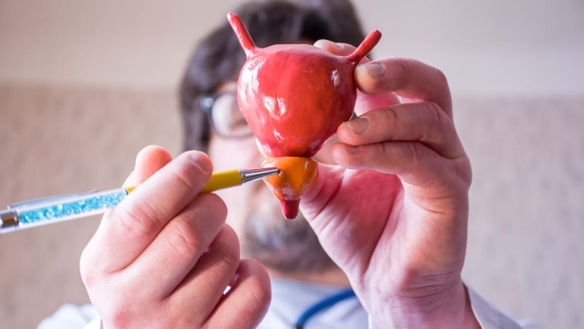 Complicatii ale adenomului de prostata: obstructie urinara si pietre la vezica