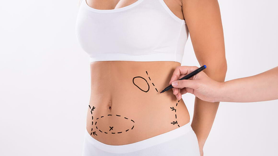 Este lipoaspiratia o solutie eficienta pentru a scapa de kilogramele in plus?