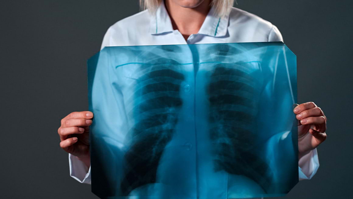 Lobectomia, cel mai eficient tratament pentru cancer pulmonar incipient