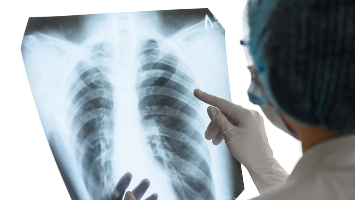 Pneumotoraxul: cauze, simptome & tratament