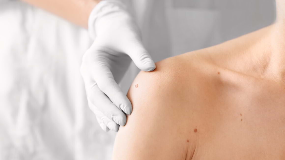 Ameliorarea prognosticului în melanomul malign