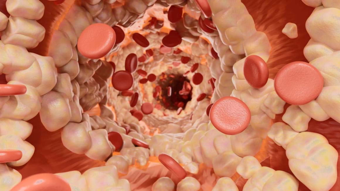 Ce este hiperlipidemia mixta: cauze, factori de risc, tratament