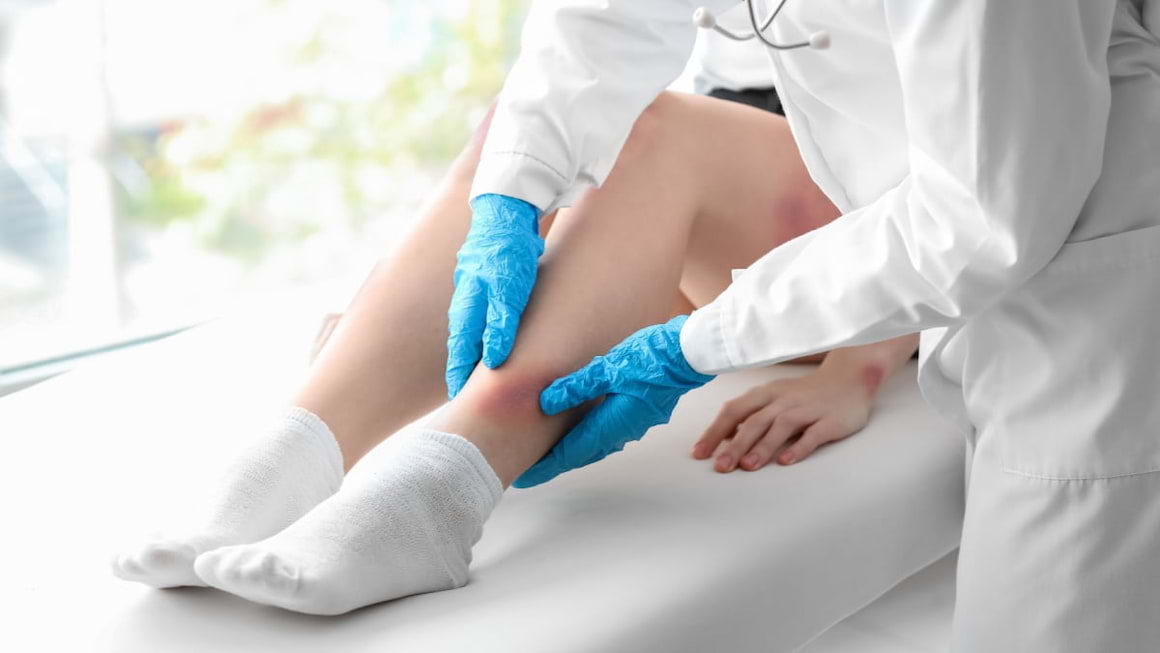 Celulita infecțioasă: ce este, tratament, prevenire