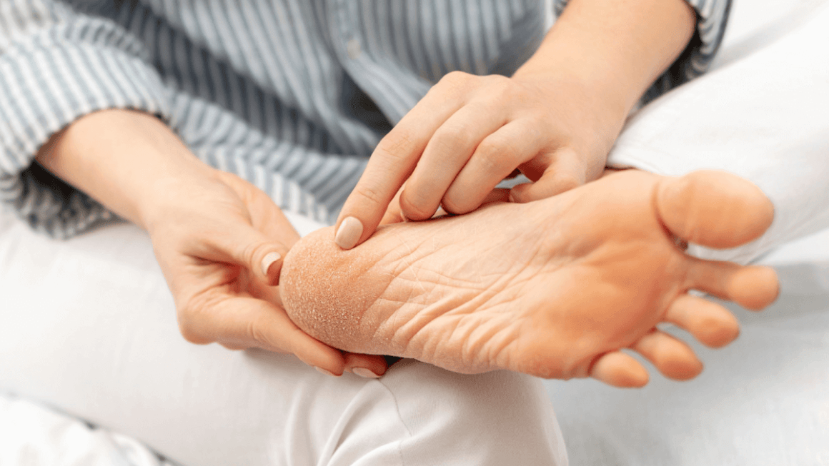 Dermatita de stază: cauze, simptome, tratament