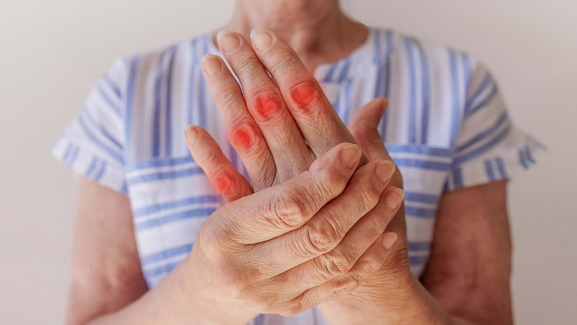 Diferenta dintre artrita psoriazica si artroza (osteoartrita)