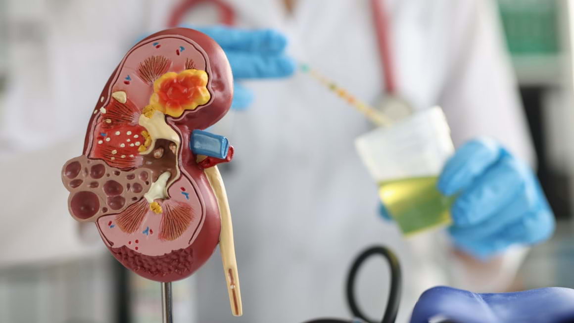 Hematuria (urinare cu sange): cauze si solutii