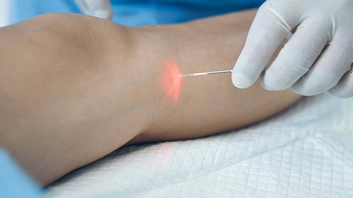 Laser simplu și laser endovenos: ce beneficii are fiecare procedura pentru tratarea varicelor