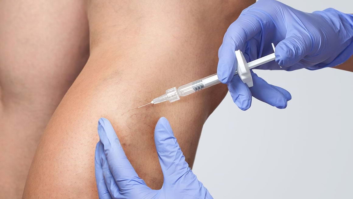 Scleroterapia: ce afectiuni trateaza, in ce consta si ce efecte secundare are