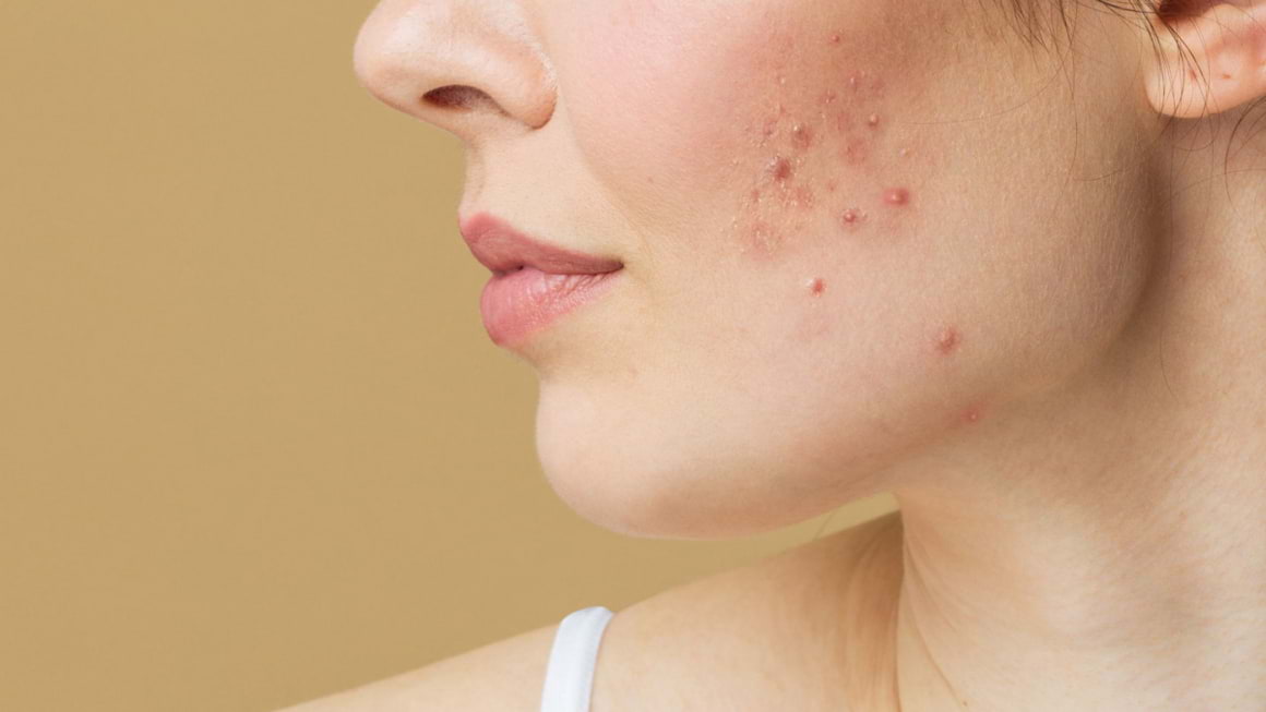 Acneea: cauze si factori care o agraveaza