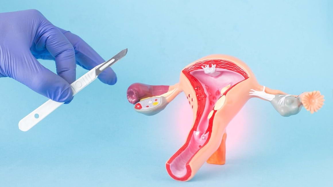 Cancer de col uterin: cauze, simptome si tratament