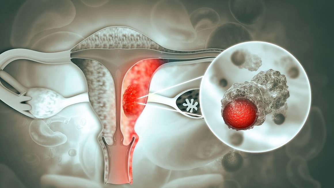 Factorii de risc în cancerul endometrial