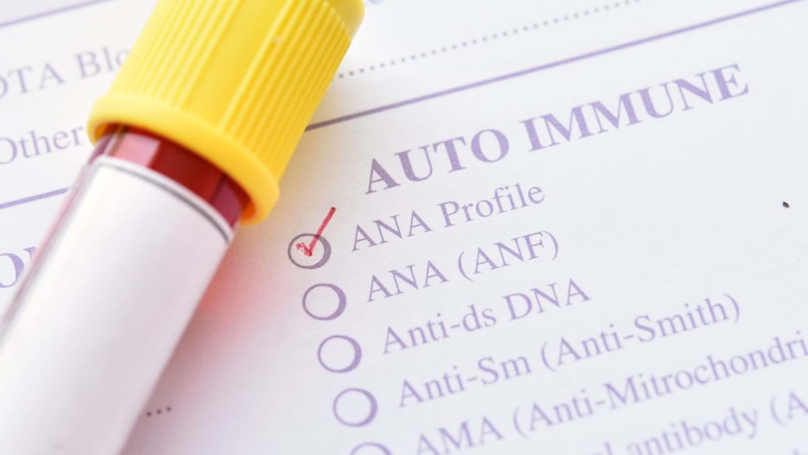 Criterii de diagnostic serologic la pacientii cu lupus