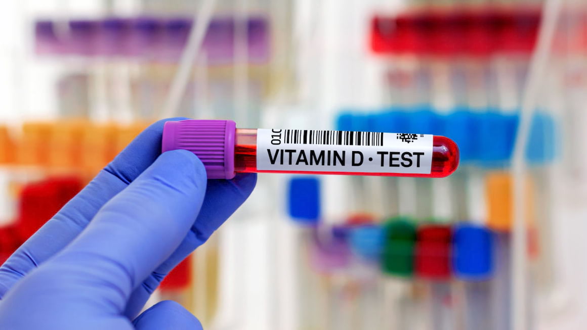Deficitul de vitamina D creste riscul de complicatii renale la pacientii cu lupus