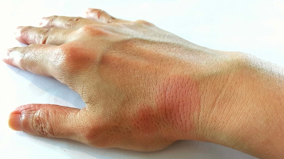 Lupus eritematos cutanat: cauze, simptome si tratament