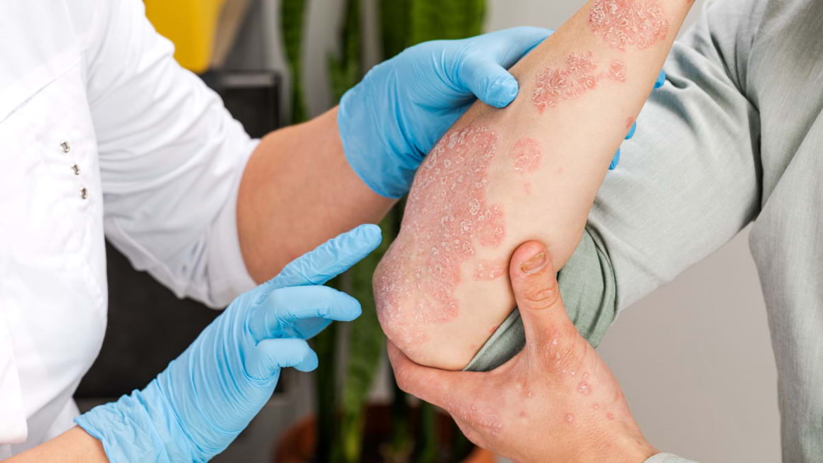 Pacientii cu psoriazis sever, risc mai mare de boli cardiovasculare
