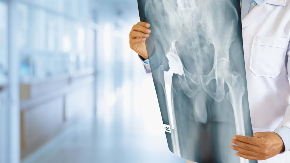 Proteza de șold (artroplastia totală de șold): când se recomandă și în ce constă recuperarea?