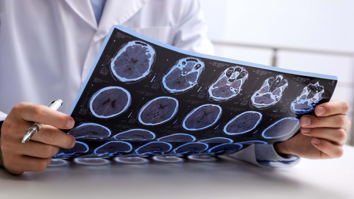 Scleroza concentrica (Balo): cauze, simptome, tratament
