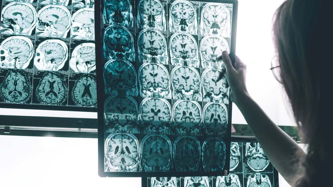 Boala Alzheimer: ce diferențe apar în creierul bolnavilor?