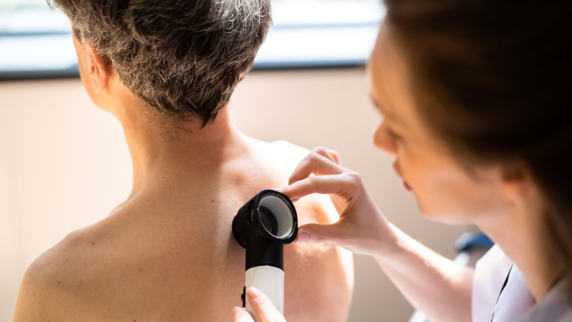 Cancerele cutanate (non-melanotice): carcinomul bazocelular si scuamos